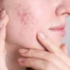 Close-up of a woman pointing to post-inflammatory redness and shallow indented acne scars on her cheek area.