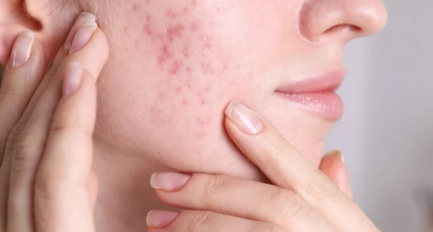 Close-up of a woman pointing to post-inflammatory redness and shallow indented acne scars on her cheek area.