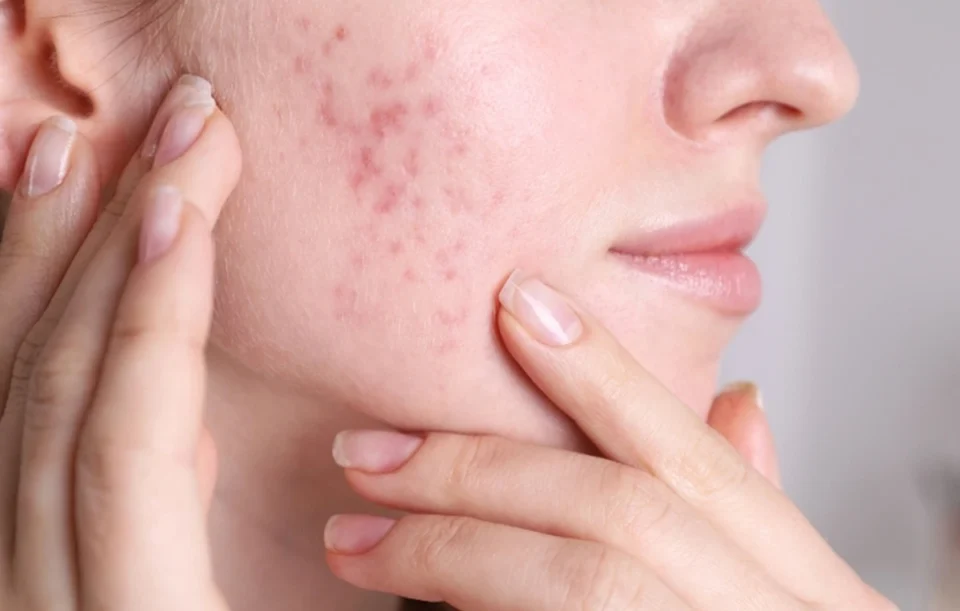 Close-up of a woman pointing to post-inflammatory redness and shallow indented acne scars on her cheek area.