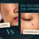 Comparison graphic showing dark patches of melasma on the cheek versus a targeted spot of hyperpigmentation below the eye with text asking "Do You Know The Difference?"